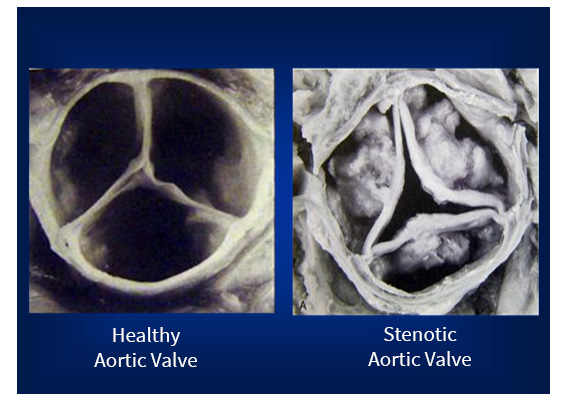 Image result for healthy aortic valve vs calcified