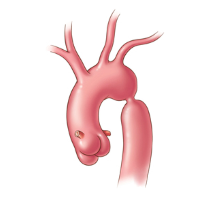 Aort Koarktasyonu Prof Dr Teoman K l 