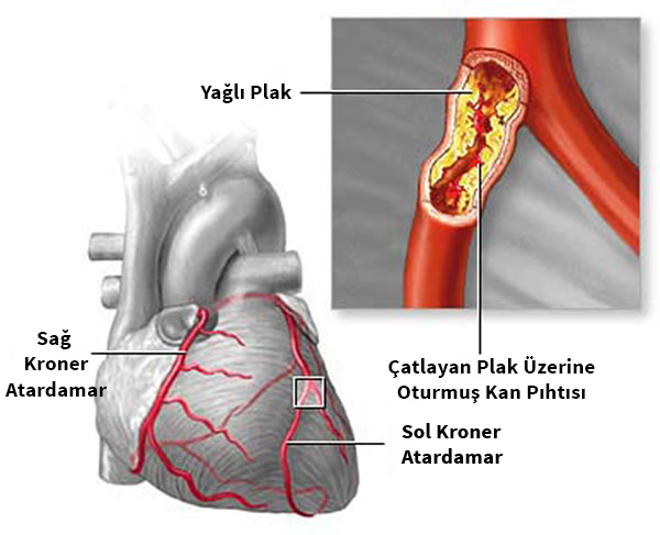 Koroner Arter Hastal Prof Dr Teoman K l 