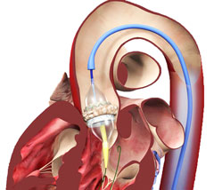 AORTIC VALVE STENOSIS