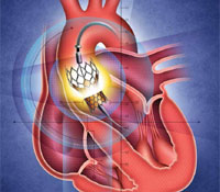 AORTIC VALVE STENOSIS