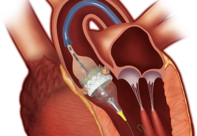 Aortic Valve Regurgitation