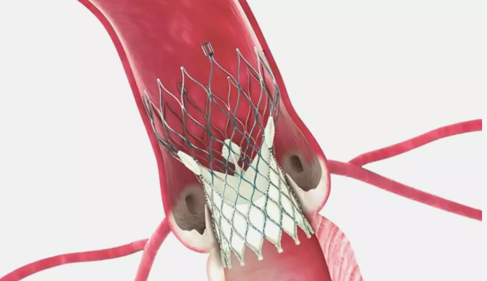 Aortic Valve Regurgitation