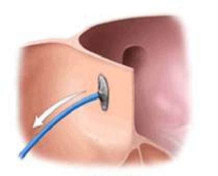 ATRİYAL SEPTAL DEFEKT
