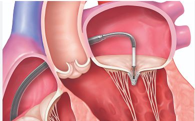 Mitral mandallama (MitraClip) işlemi