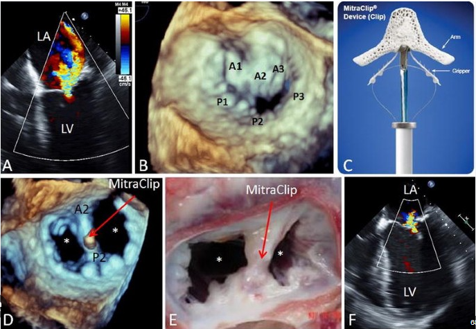 Mitral mandallama (MitraClip) işlemi