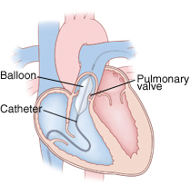 PULMONER DARLIK 