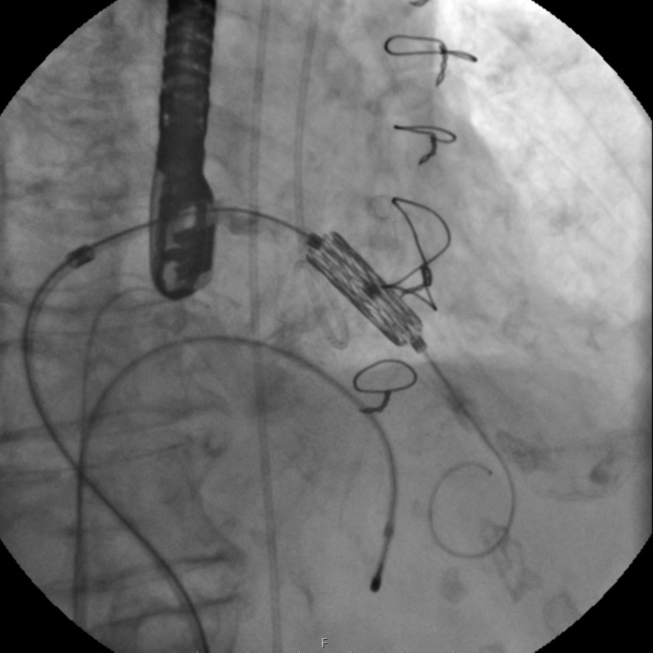 TMVR Image 1