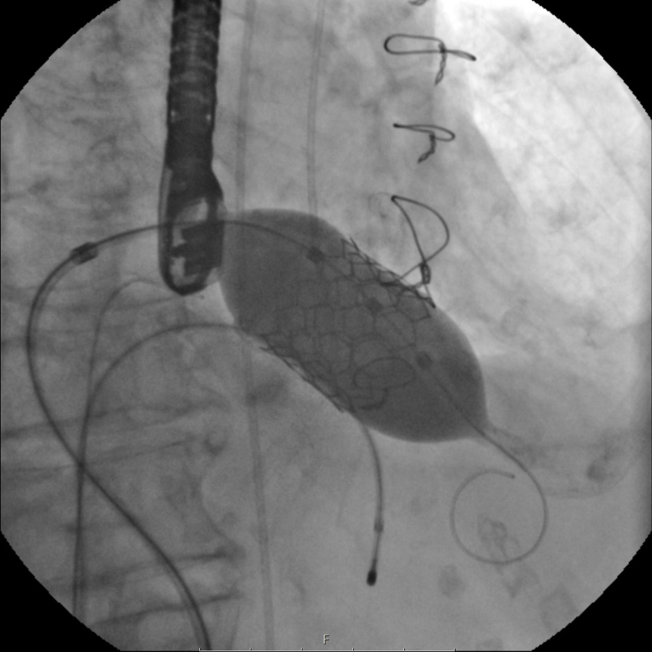TMVR Image 2