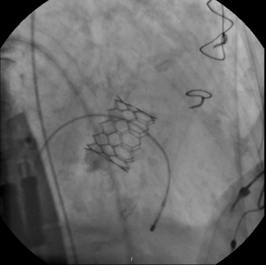 TMVR Image 3