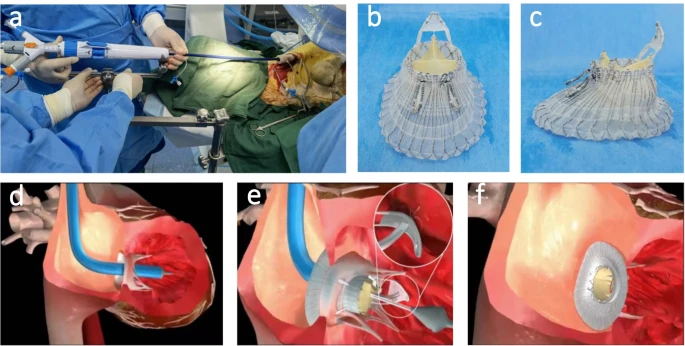 Transcatheter Tricuspid Valve Replacement (TTVR)