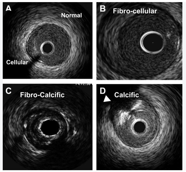 IVUS images: normal/cellular, fibro-cellular, fibro-calcific and calcific plaque