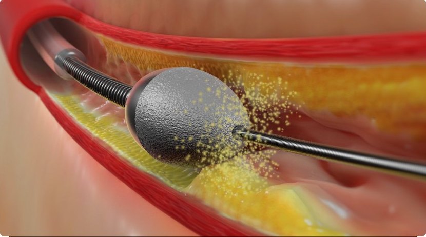 Rotablator: the diamond-coated burr ablating calcified plaque
