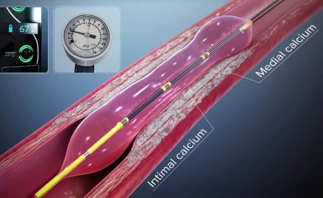 Shockwave lithotripsy balloon: intimal and medial calcium fractured by shock waves