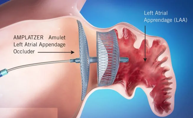 Amplatzer Amulet LAA occluder device