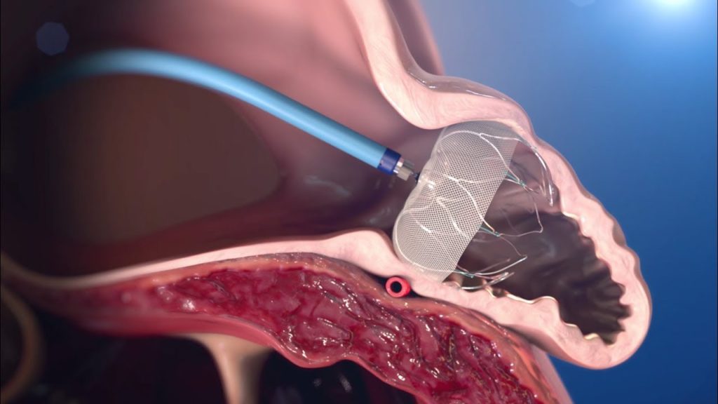 Left atrial appendage anatomy