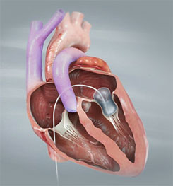 MITRAL VALVE STENOSIS
