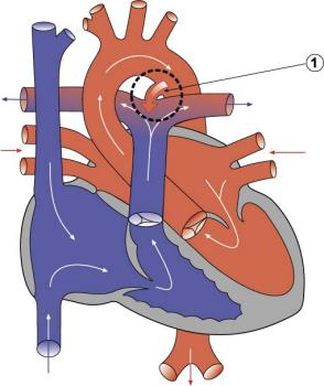 PATENT DUCTUS ARTERIOSUS (PDA)